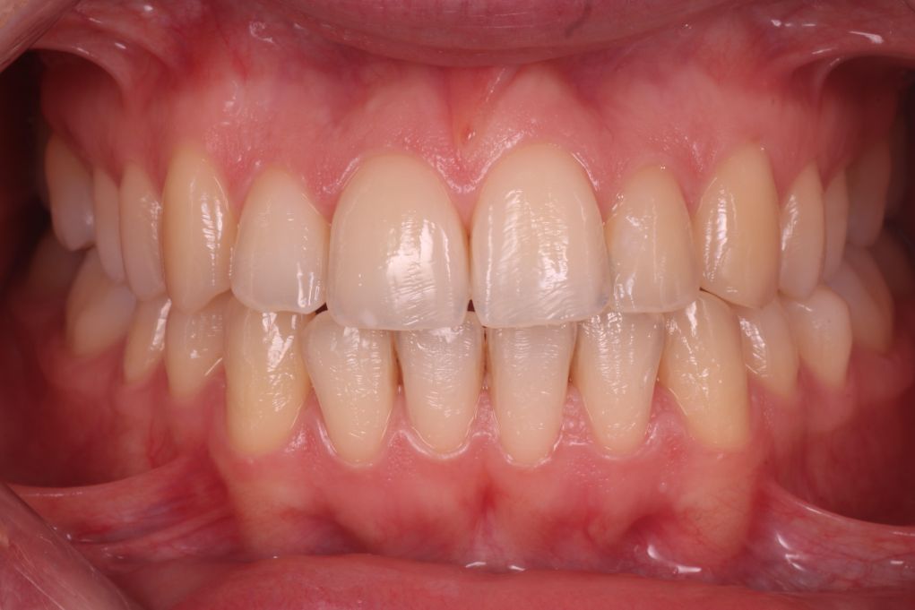 Blanqueamiento dental: tipos, cuánto dura y precio