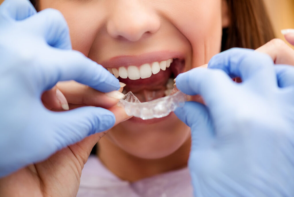 Ortodoncia invisible: Invisalign y lingual | Opciones