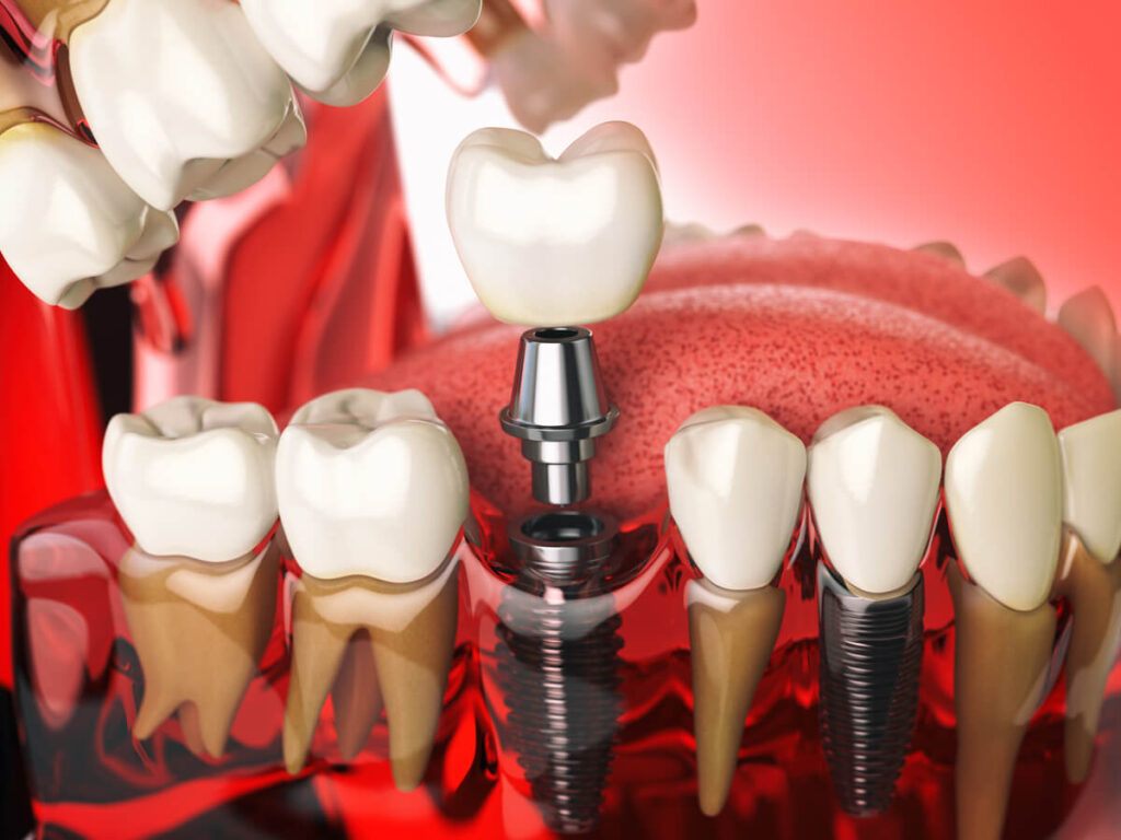 Implantes de carga inmediata: qué son y requisitos