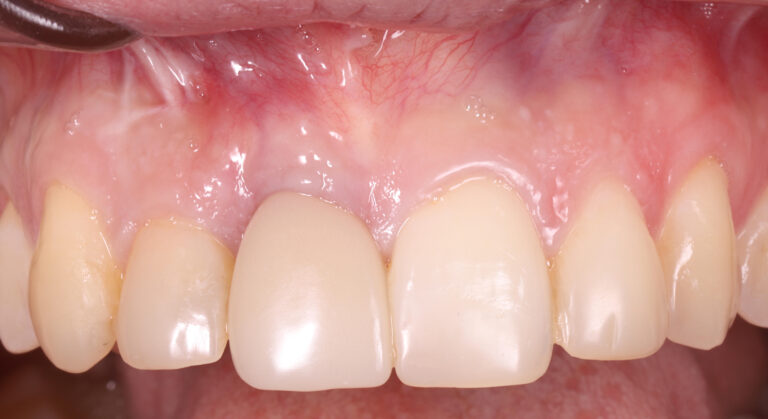 Periodoncia y encías